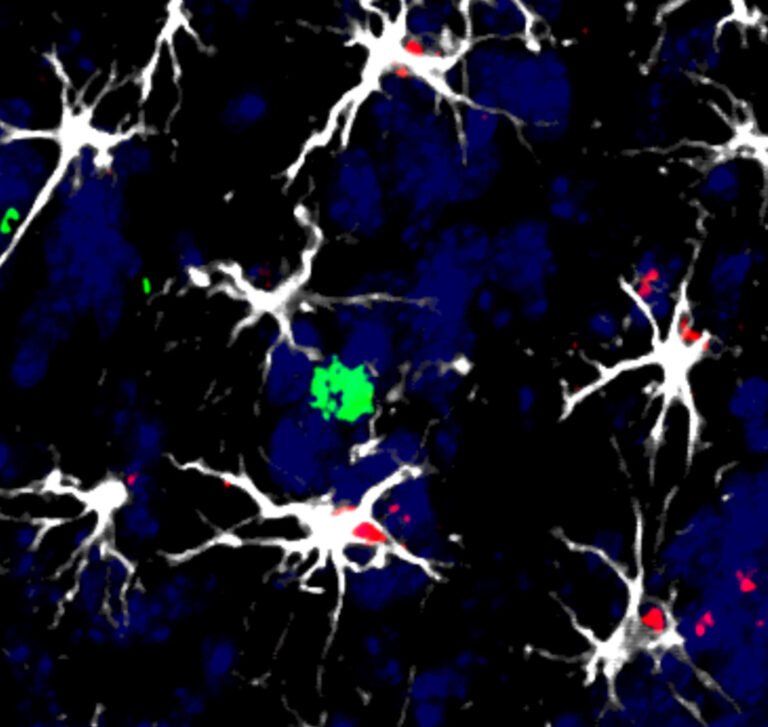 Descubren células clave que facilitan la metástasis cerebral y proponen nuevo tratamiento